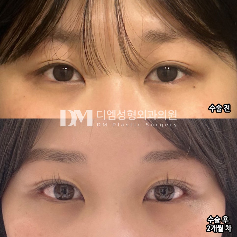빵트임 후기."생각했던 거 보다 많이 트여서 정말 만족 합니다 !!" 관련 이미지 2