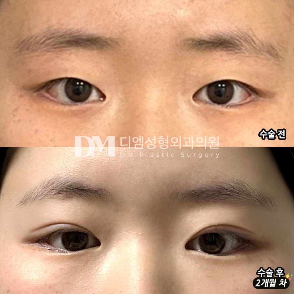 Eye Surgery Review. “I’m happy that the result is even better than I expected. Thank you.” image 2