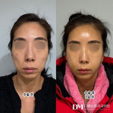 Facial Fat Grafting for a Vibrant, Youthful Appearance! image 6