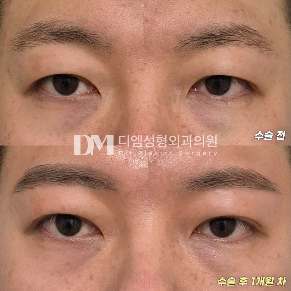 눈성형 후기."붓기도 빨리 빠지고 통증도 없었어요 :) " 관련 이미지 2