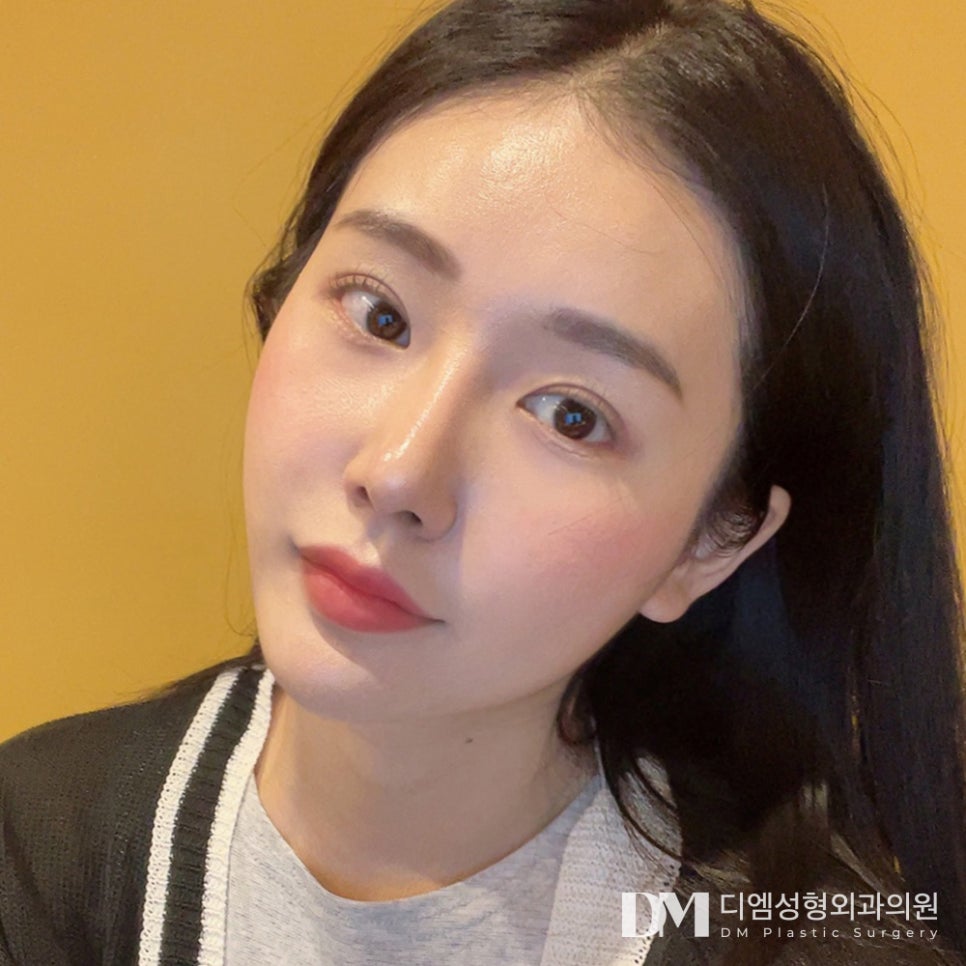 눈밑지방재배치, 동안 효과 뿐 아니라 환한 인상까지 ! 관련 이미지 1