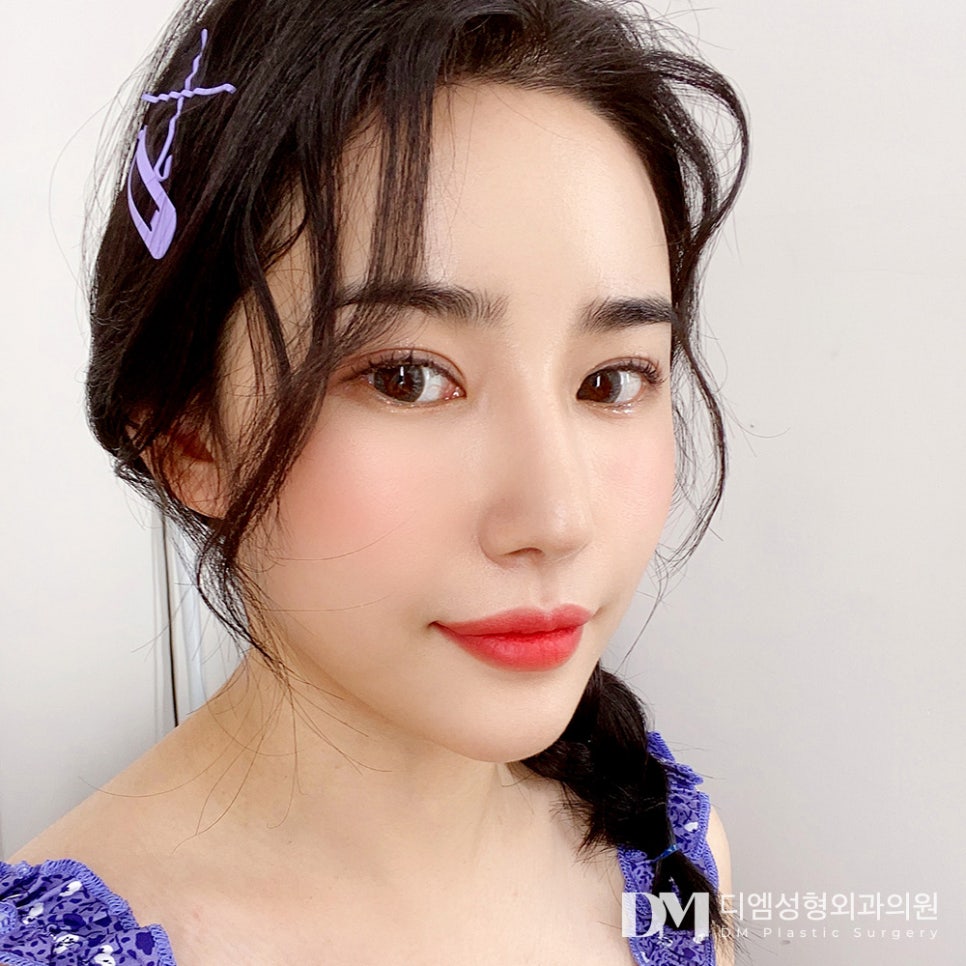 긴코,화살코 성형 짧은 중안부가 대세! 관련 이미지 10