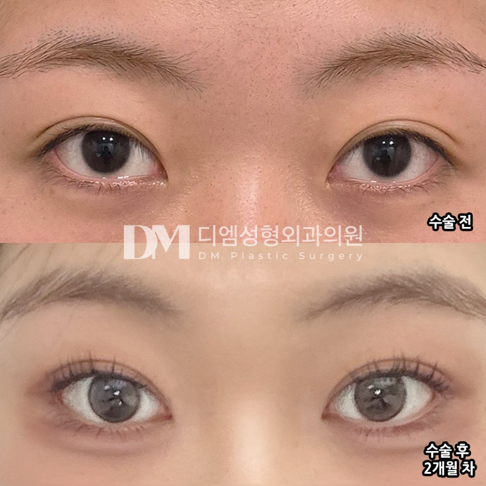 디엠 뒤밑트임 수술후기, “눈 자연스럽게 길어 보이고 답답한 느낌이 많이 사라졌어요!” 관련 이미지 2