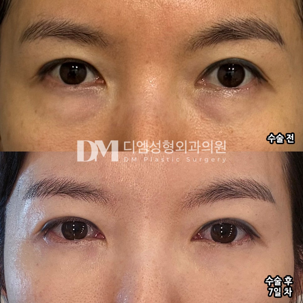 눈밑지방재배치로 다크서클과 노안 개선이 가능할까?? 관련 이미지 6
