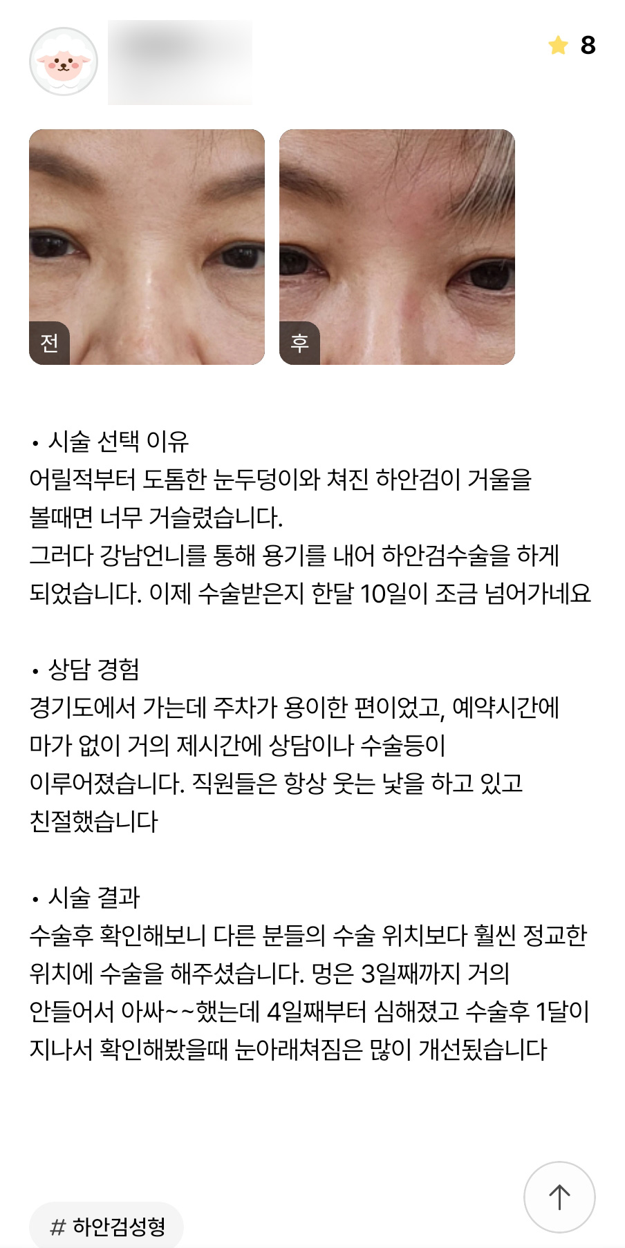 Lower Blepharoplasty Review: “The Sagging Under My Eyes Has Improved a Lot!” image 1