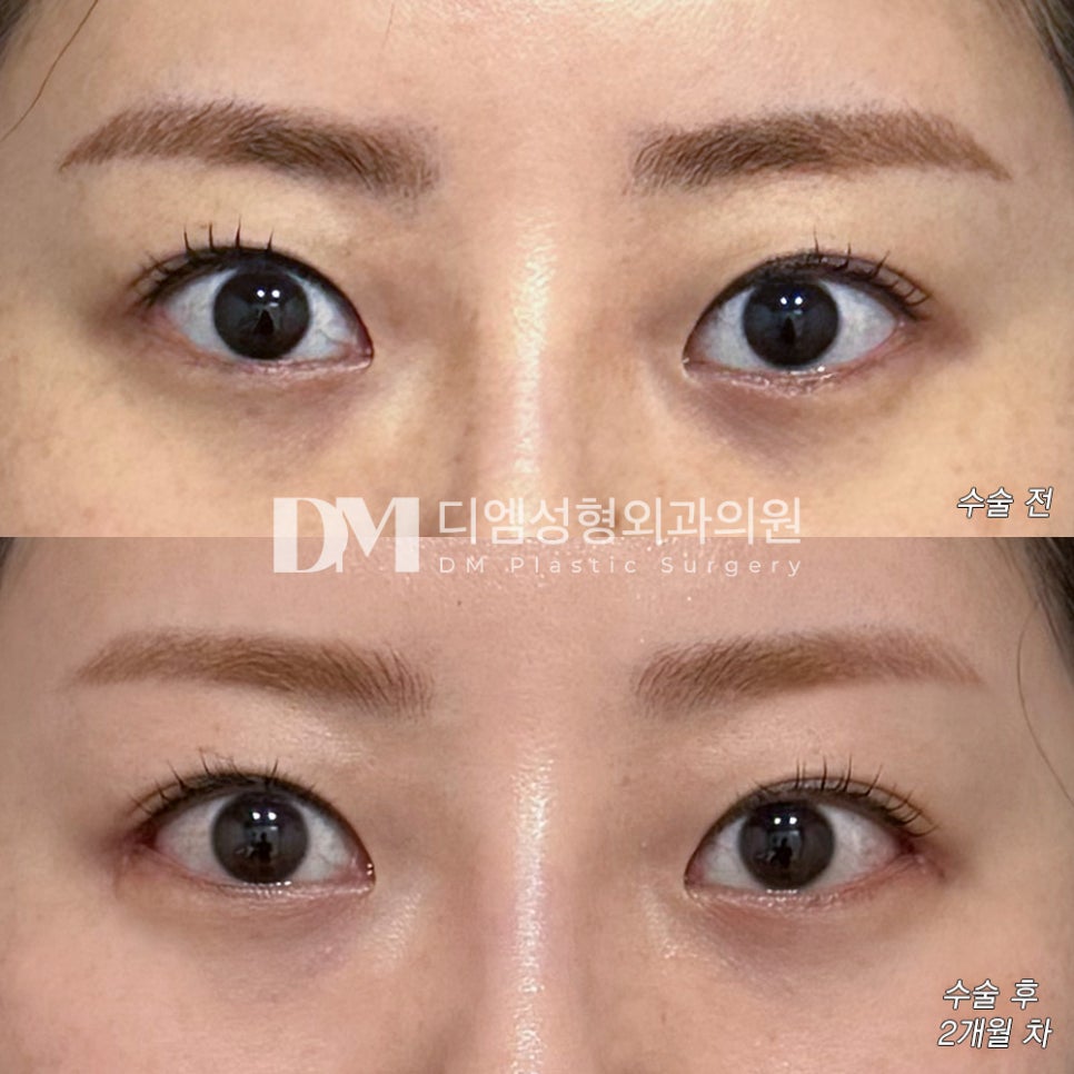 Lower Outer Canthoplasty Review. "I’m satisfied because it feels like my eye shape has been naturally widened!" image 2