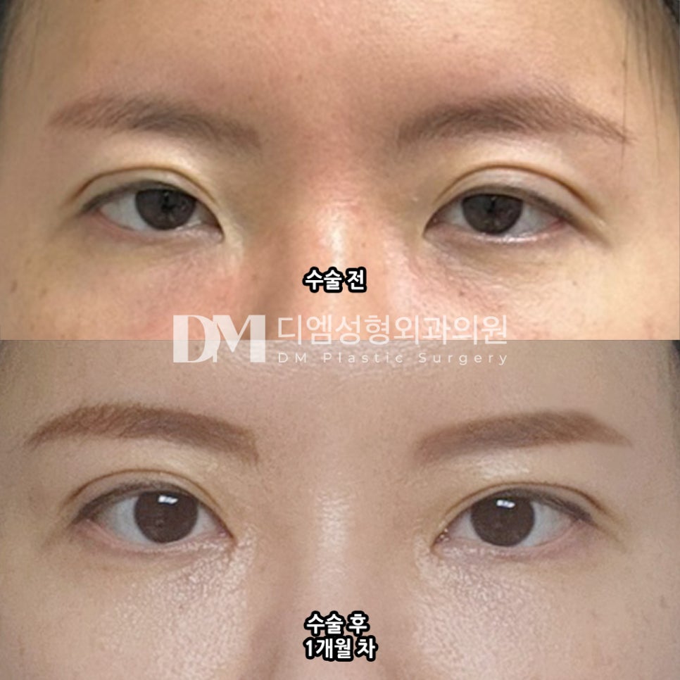 Double Eyelid Surgery Review. "There was almost no pain, so it didn’t affect my daily life at all!" image 2