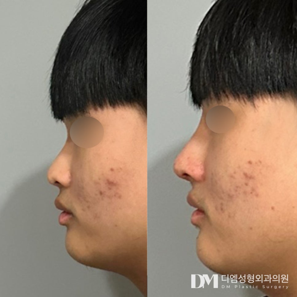 코성형 후기."통증도 거의 없고 모두 친절해요!" 관련 이미지 2