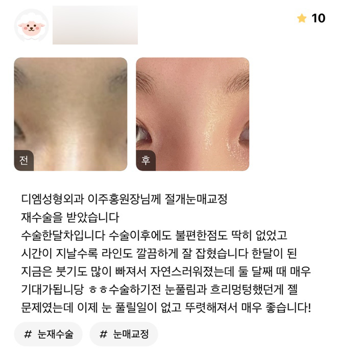 Review of Revision Eyelid Surgery: “I’m very happy that my eyes are now defined and won’t become loose again!” image 1