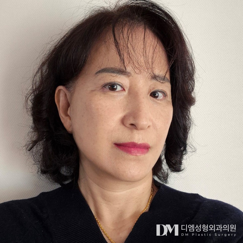 안면거상, 잃어버린 자신감 되찾기 ! 관련 이미지 16