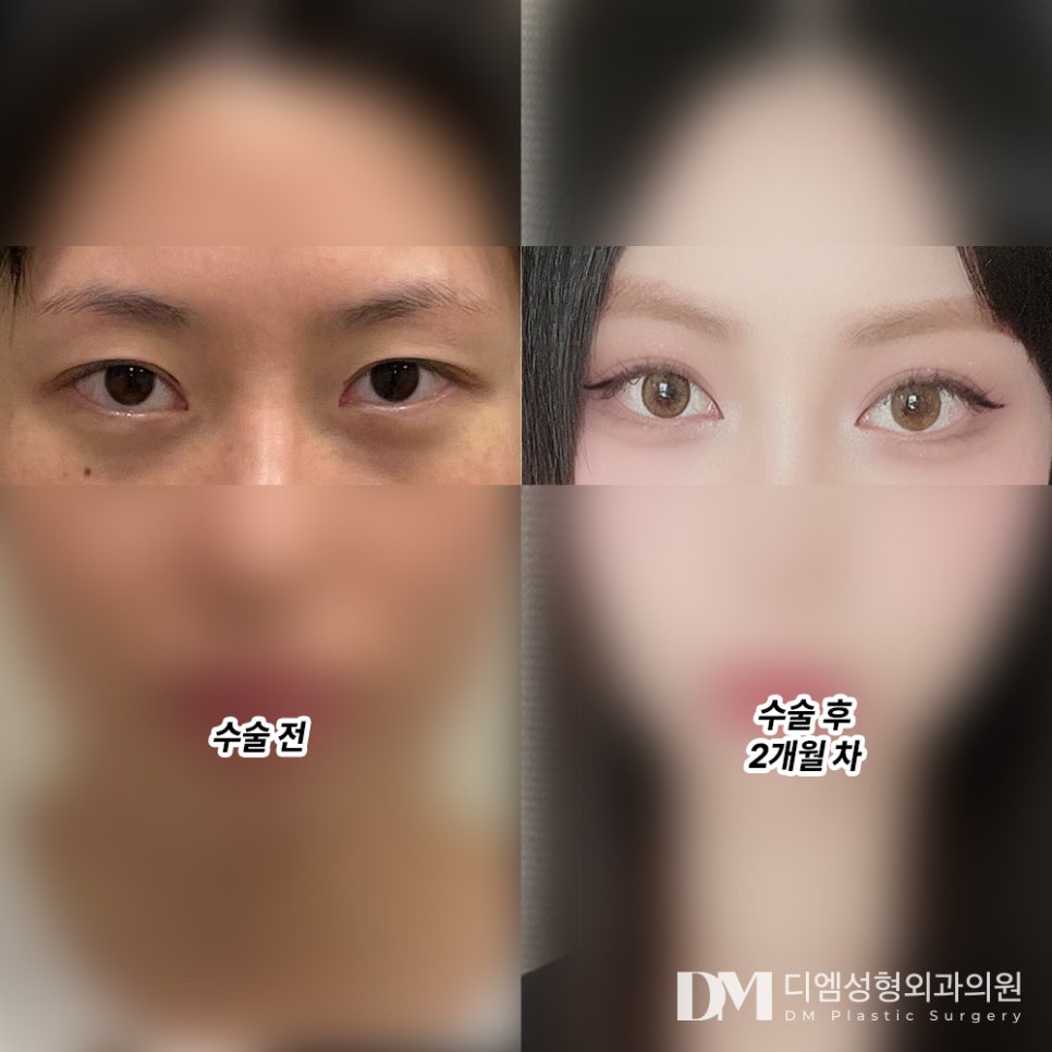 눈재수술 후기."붓기 다 빠진 모습이 궁금해요!" 관련 이미지 2