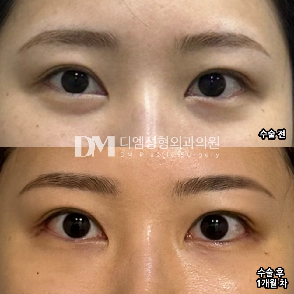 Bbang Teum Review. "I like it even more because it’s a surgery that makes you look naturally prettier!" image 2