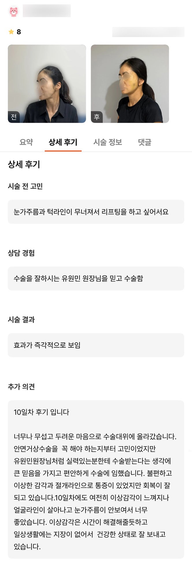 안면거상 후기."얼굴 라인이 살아나고 눈가 주름이 안 보여서 너무 좋았습니다." 관련 이미지 1