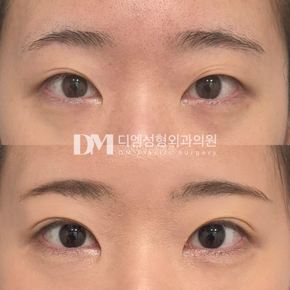 Eye Surgery Review: “I like that opening my eyes feels comfortable and the crease is well-defined!” image 2