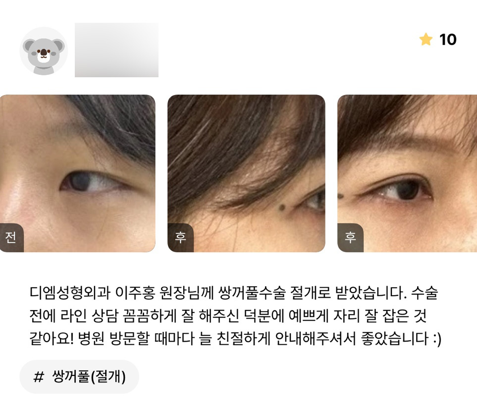 눈성형 후기."이쁘게 자리 잘 잡아서 만족스러워요!" 관련 이미지 1