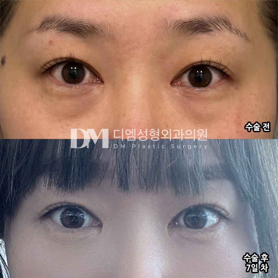 눈 밑 개선으로 환한 동안 인상 되기 관련 이미지 6