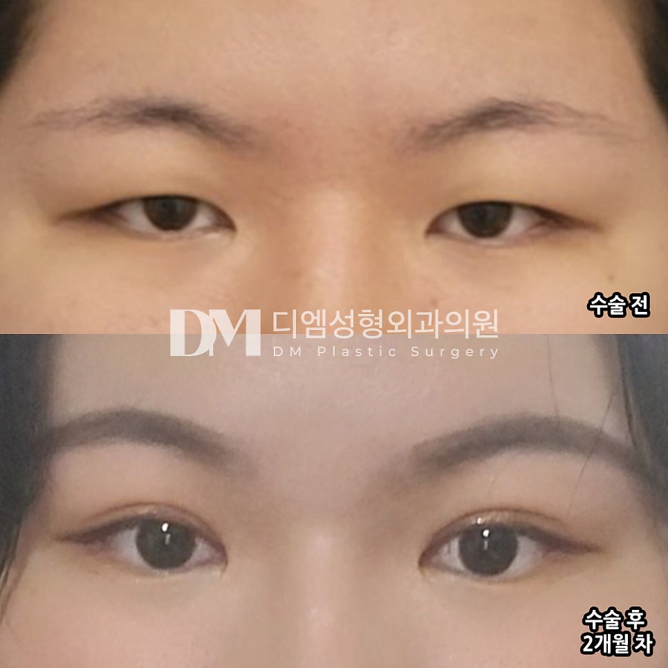 Review of Eye Surgery. "I’ve Started Enjoying Makeup!" image 2