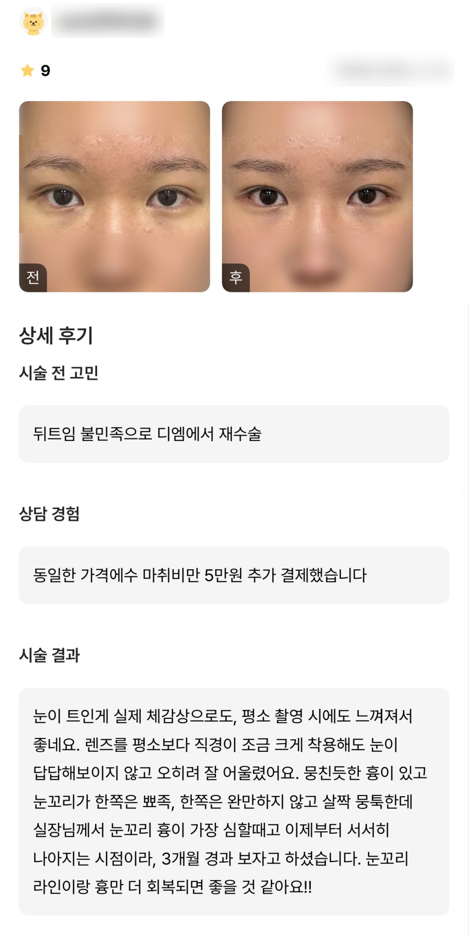 DM Canthoplasty Revision Surgery Review, “I’m glad the eyes look more open both in photos and in real life!” image 1