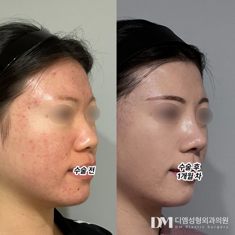 코성형 후기."회복도 잘 되고 있어 만족합니다!" 관련 이미지 2