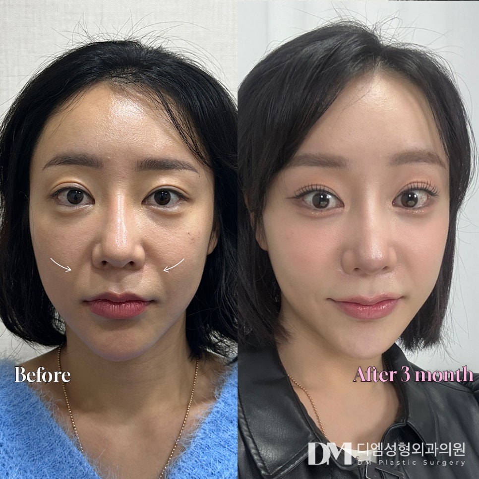 반거상, 안면거상의 차이와 고려해볼 사항은? 관련 이미지 7
