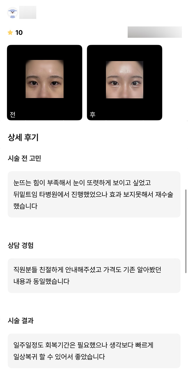 눈성형 후기."빠르게 일상 복귀가 가능해 좋았어요!" 관련 이미지 1
