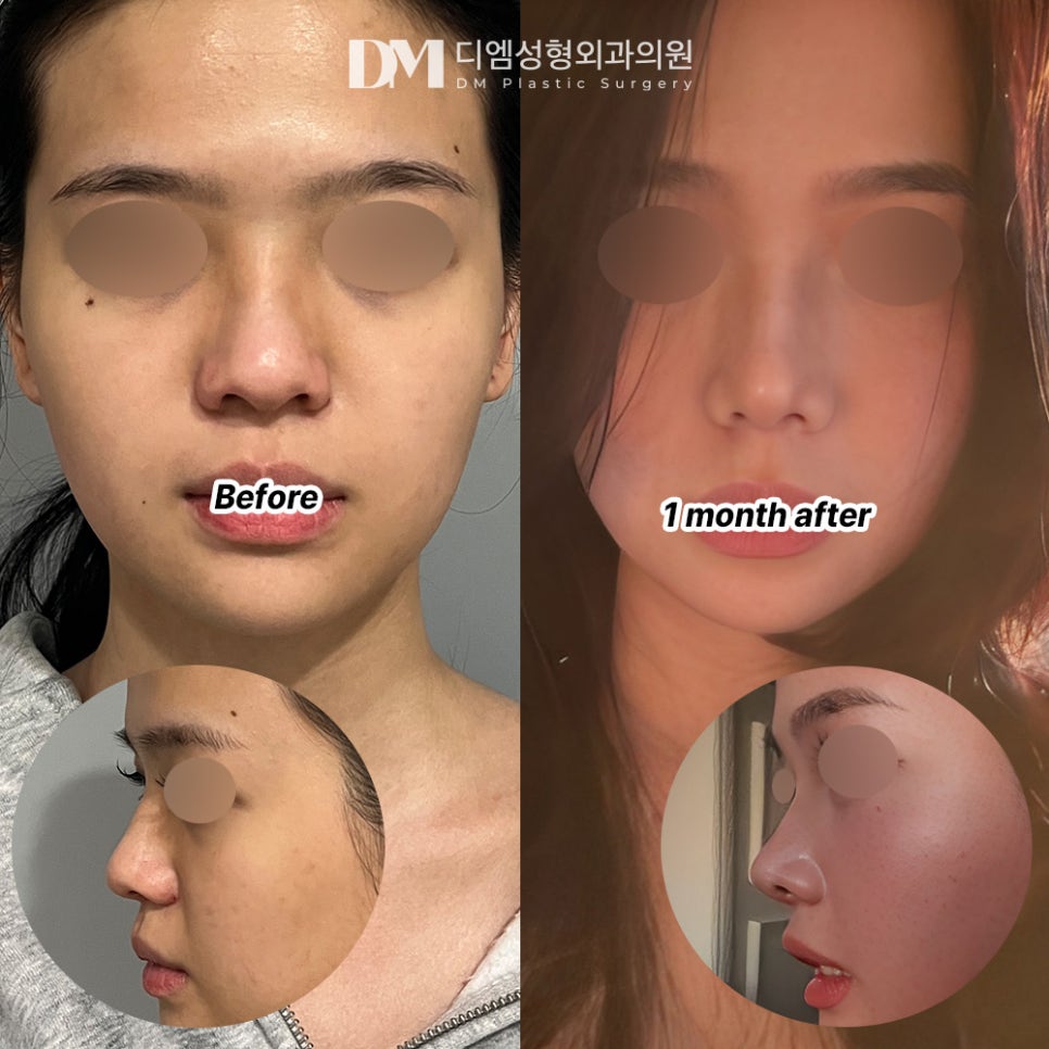 코 끝만 개선 가능할까? 관련 이미지 8