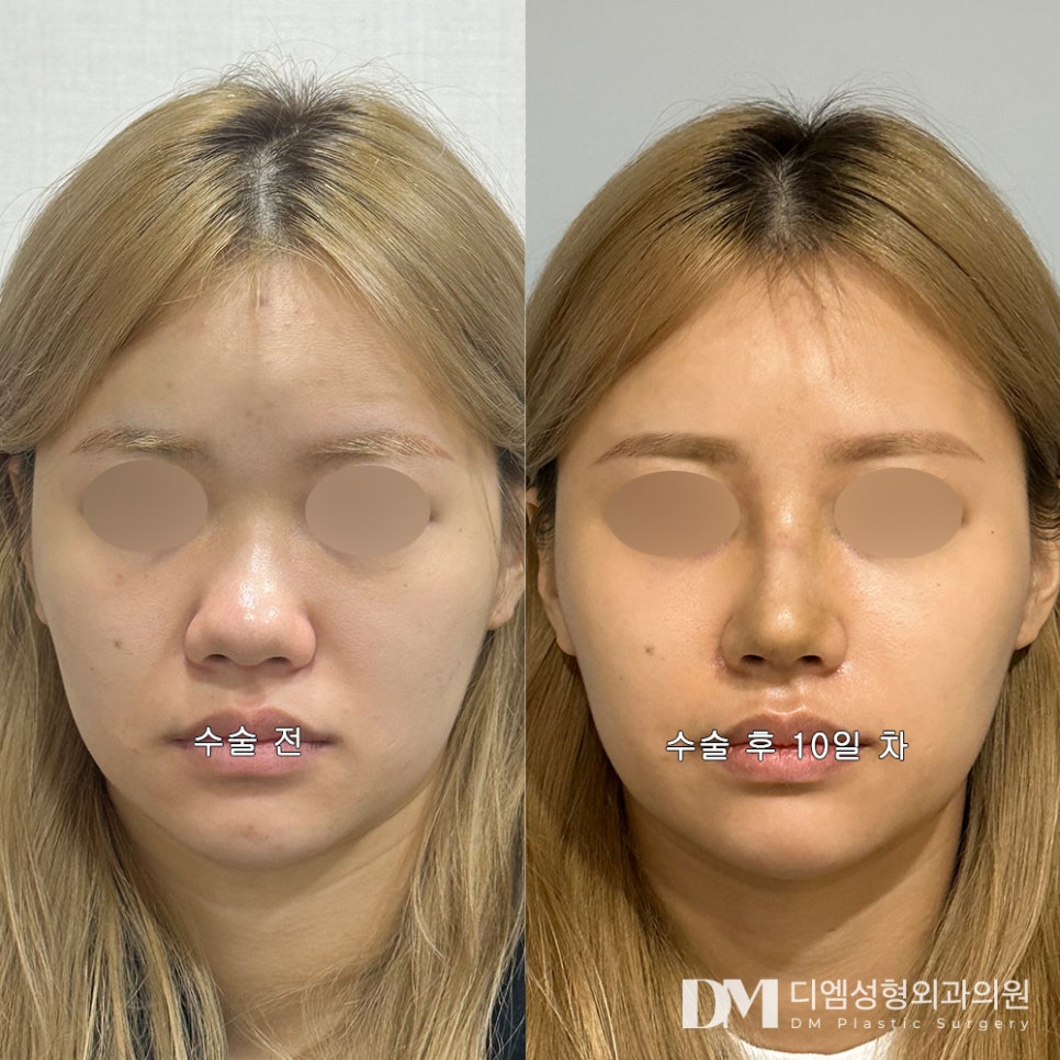 Bulbous Nose Surgery: Make a Dull-looking Image Trendy! image 10