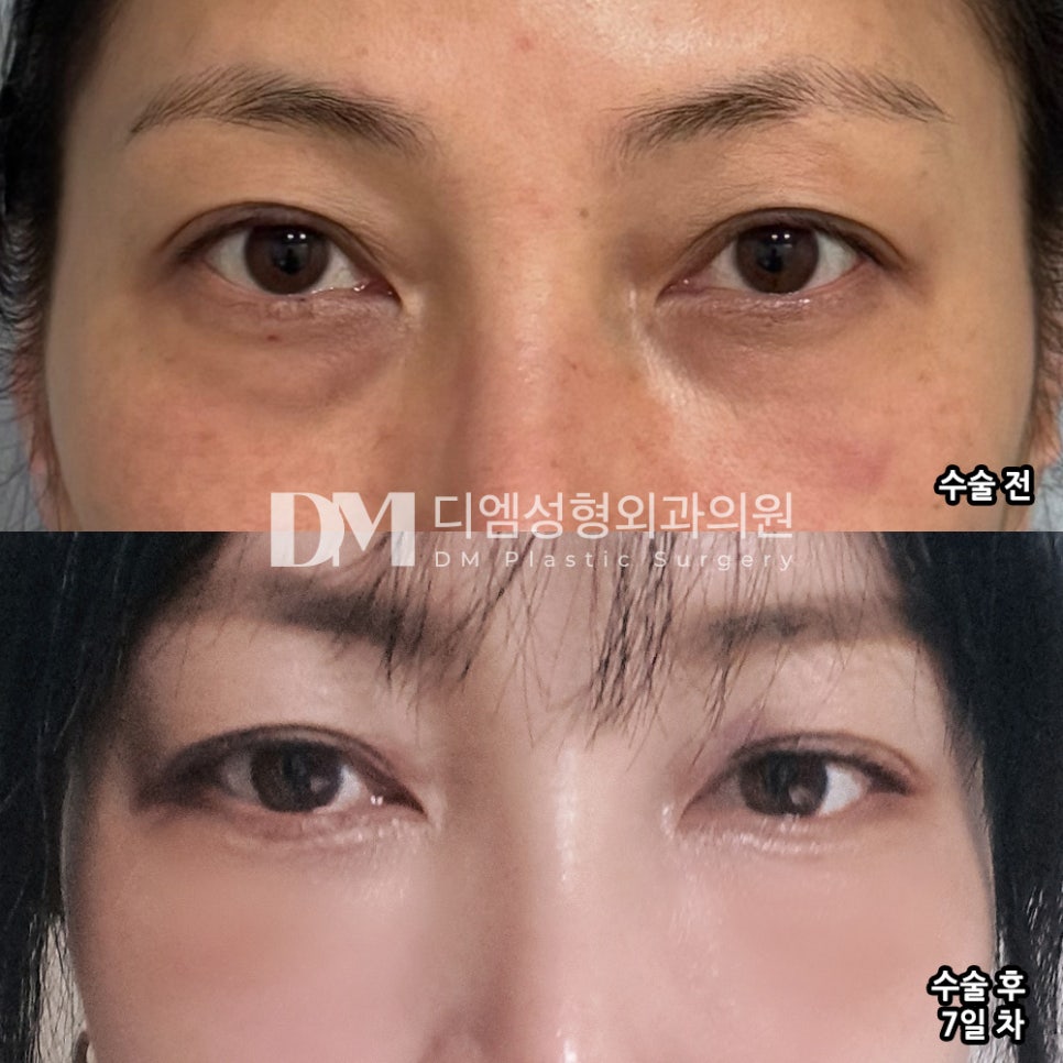 눈밑지방재배치, 어둡고 우울한 인상 탈출하자 ! 관련 이미지 6