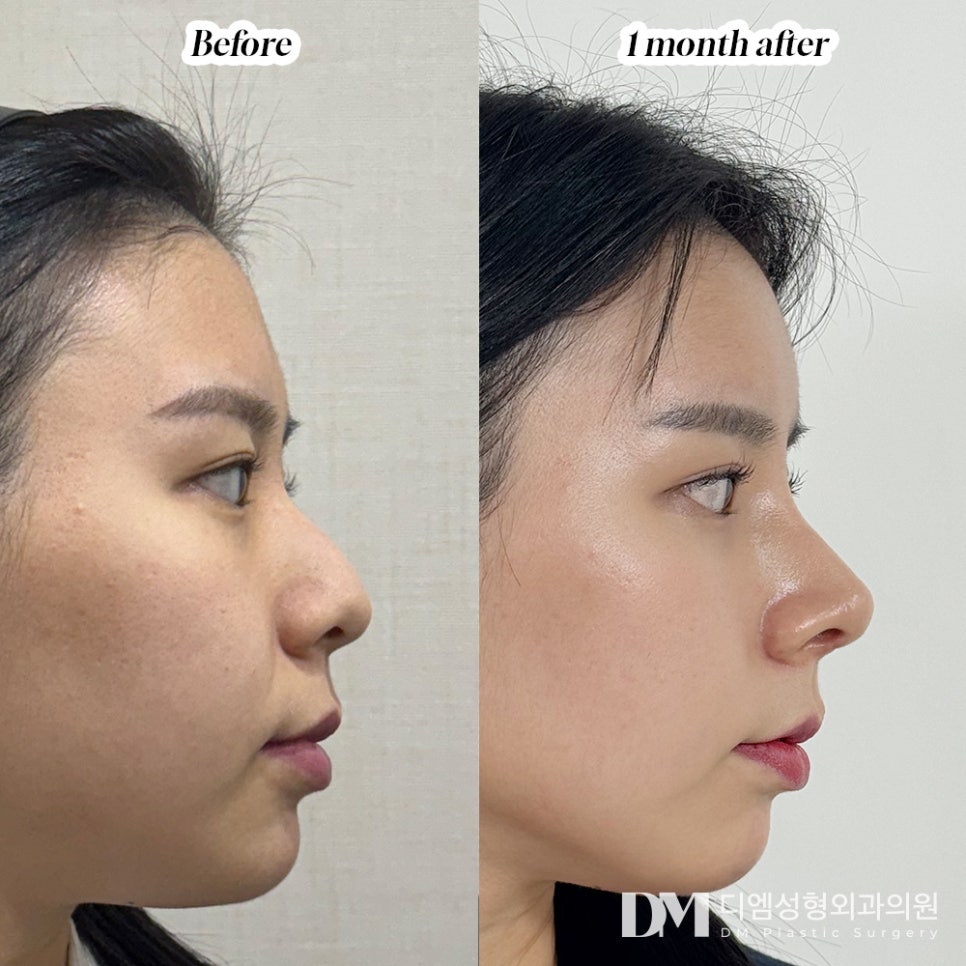 Hump Nose: Correcting It Naturally and Refinedly image 6