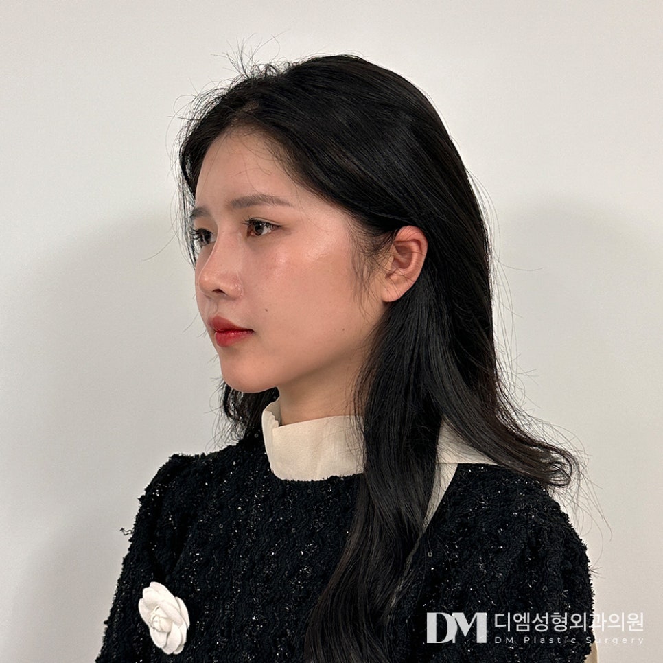 반거상, 안면거상의 차이와 고려해볼 사항은? 관련 이미지 1