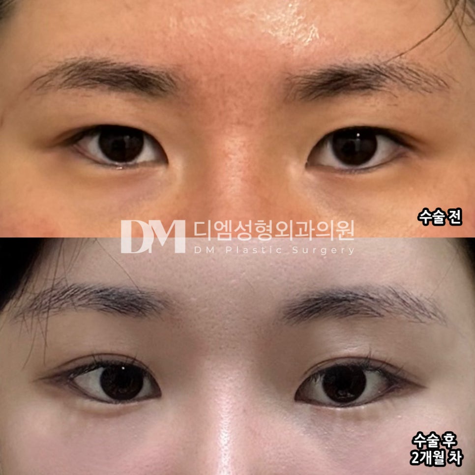 Bbang Eye Corner Surgery Review: "My eyes look less cramped than before, and my narrow eyes have improved!" image 2