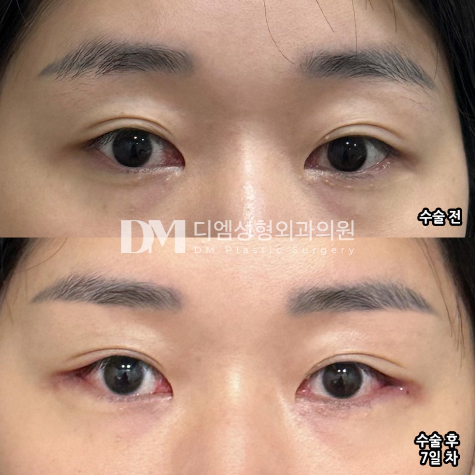 뒤밑트임 후기."솔직하게 말씀하시면서 천천히 생각하라고 말해주셔서 더 좋았습니다" 관련 이미지 2