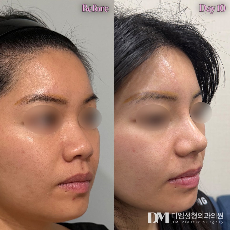 짧은코성형, 무조건 늘리고 높이기 보다 자연스럽게 맞춤형으로! 관련 이미지 8