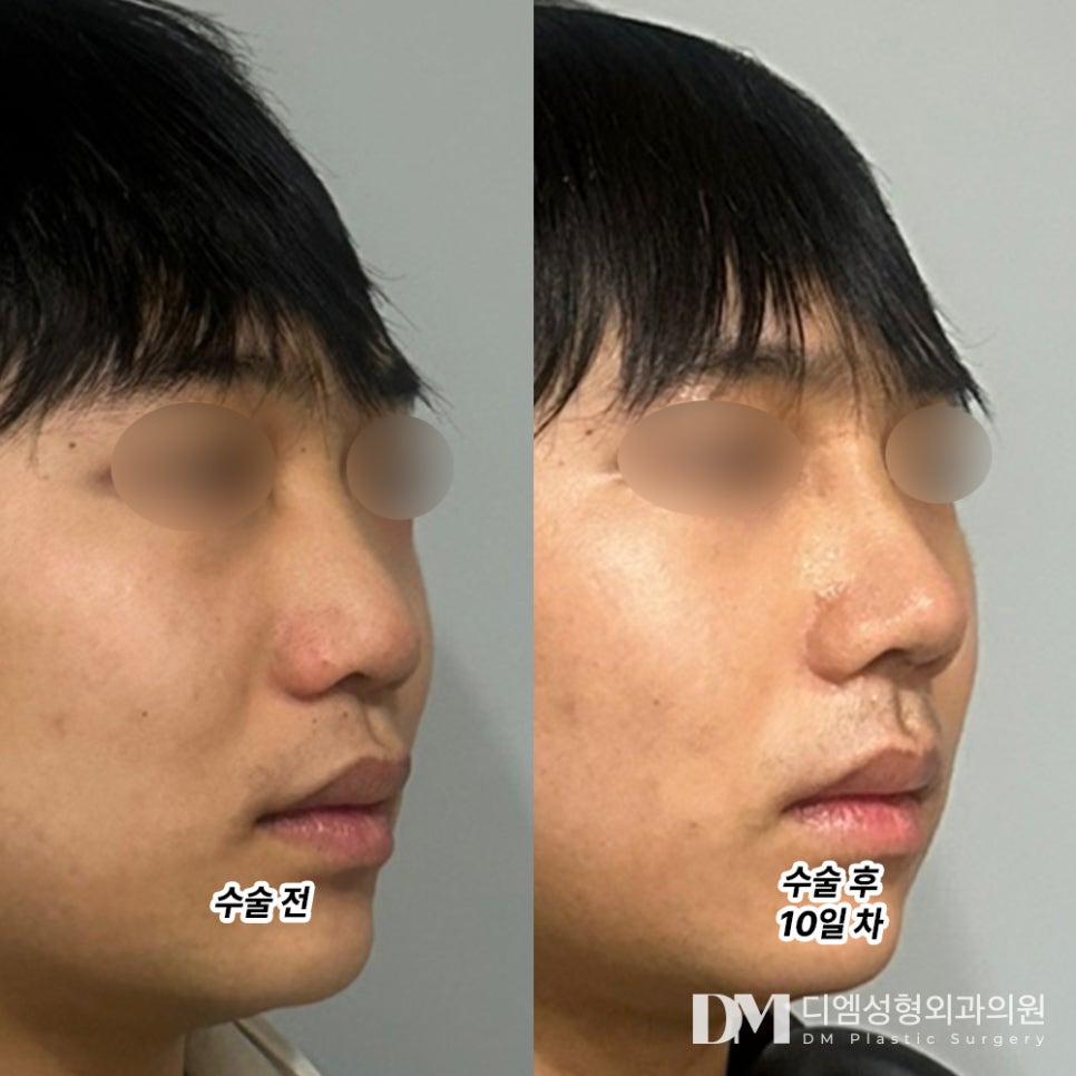 코끝성형, 뭉툭한 코가 스트레스라면?! 관련 이미지 8