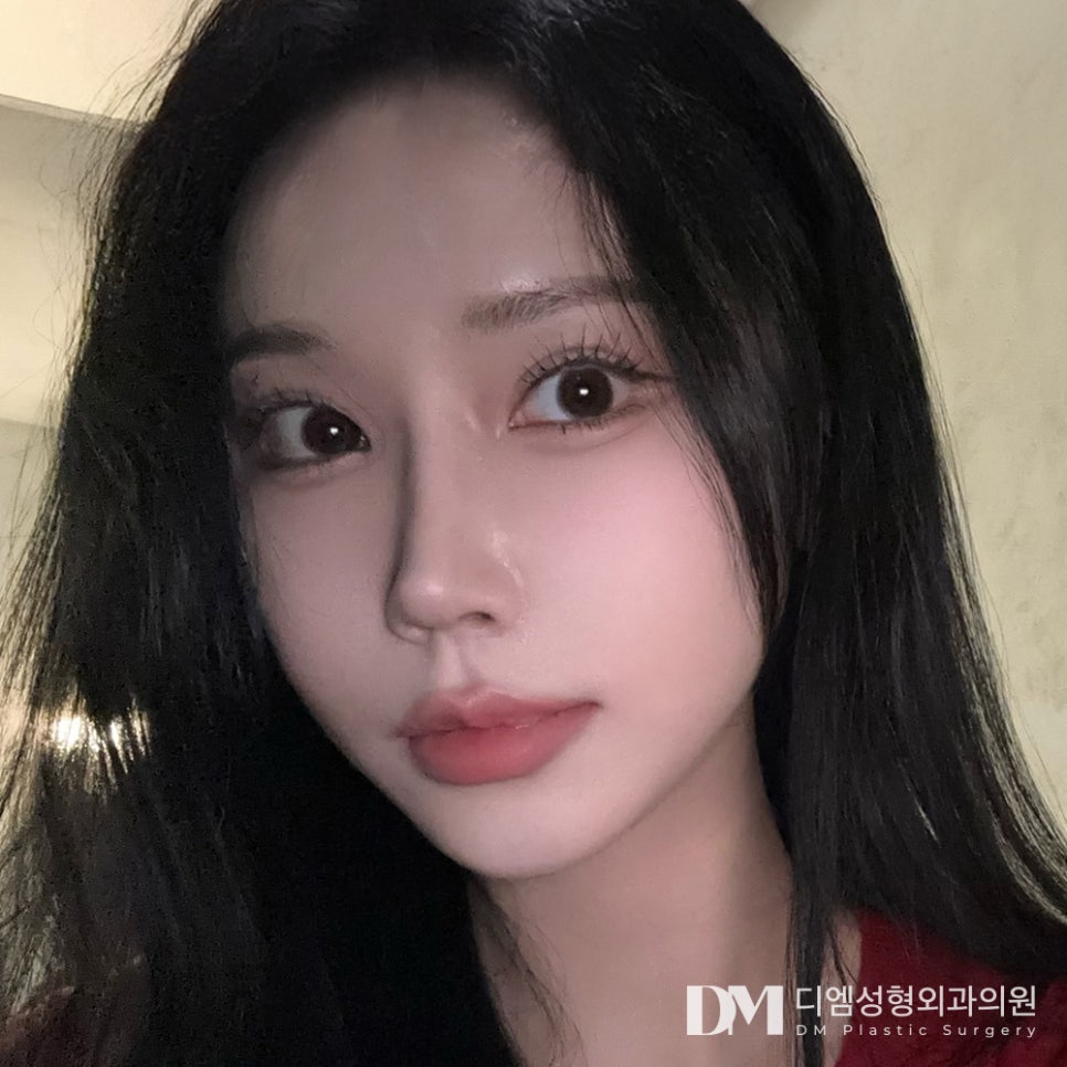 눈재수술, 나에게 맞는 자연스러운 라인으로 관련 이미지 1