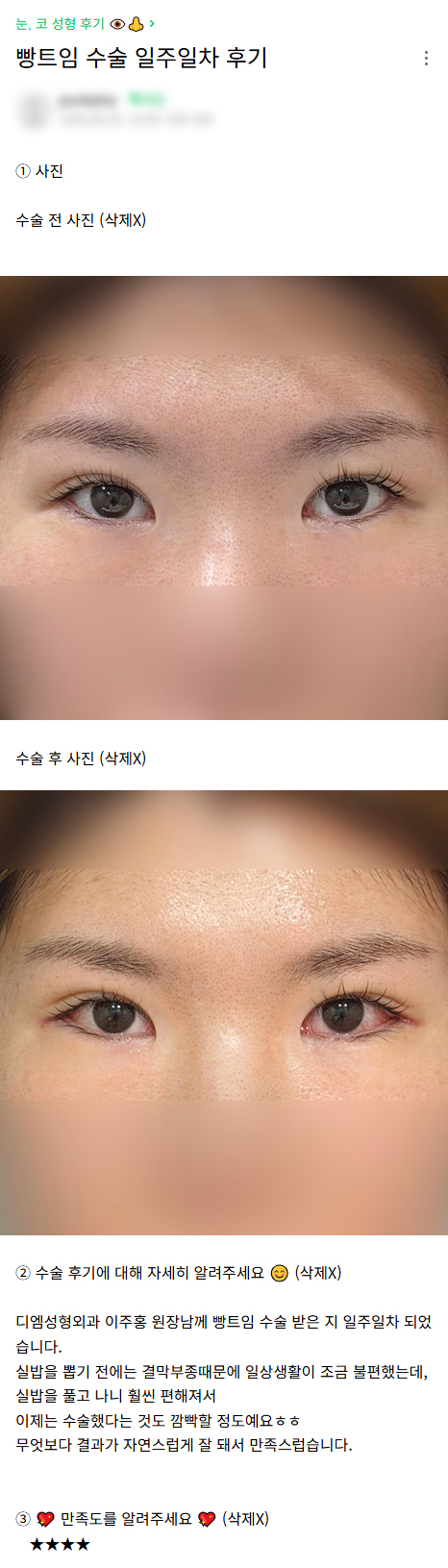 디엠 뒤밑트임/트임성형 후기, “자연스럽게 잘 돼서 만족스럽습니다!” 관련 이미지 1