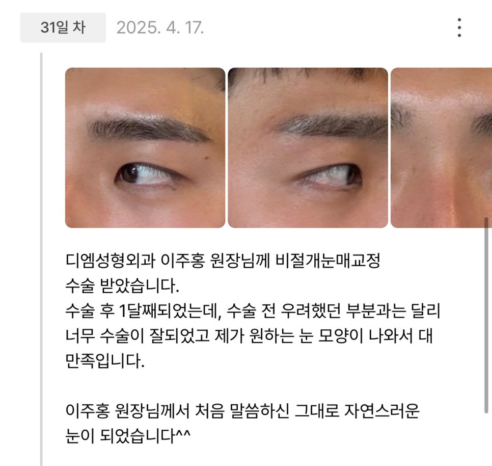 눈성형 후기."제가 원하는 눈 모양이 나와서 대만족입니다!" 관련 이미지 1