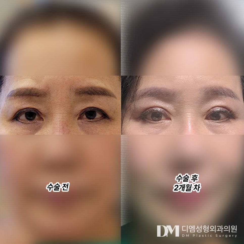 Improving Droopy Eyes with Upper Blepharoplasty image 11