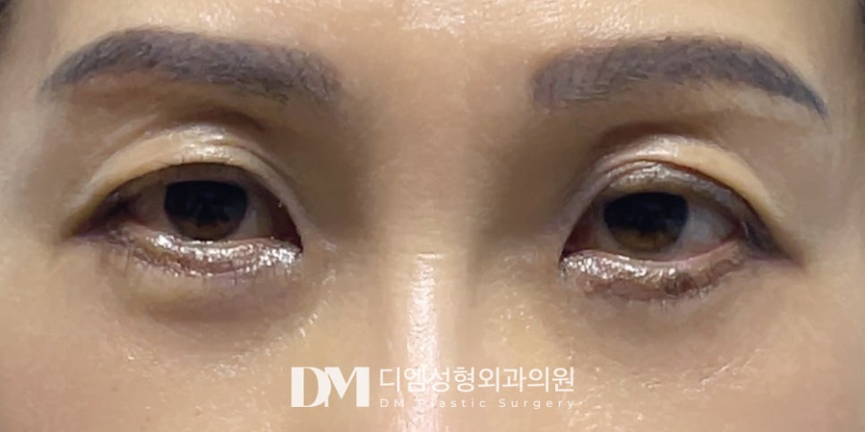 하안검, 미적 개선과 기능 회복까지 동시에! 관련 이미지 8