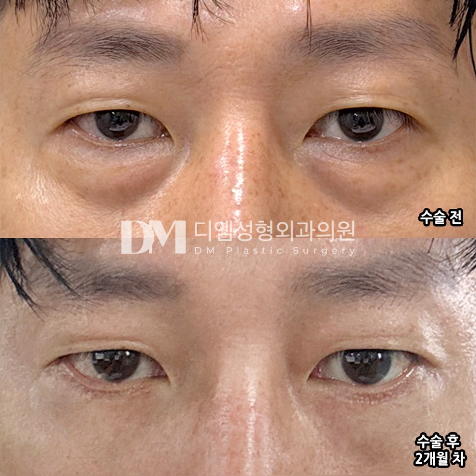 디엠 하안검 수술후기, “하안검 수술 만족도가 매우 높습니다!” 관련 이미지 2