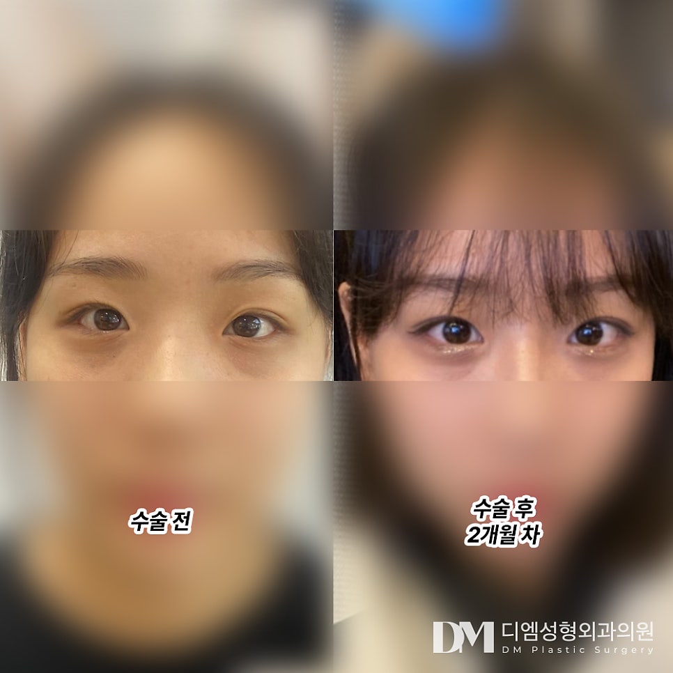 앞트임 후기."열에 아홉은 티가 안난대요 ! " 관련 이미지 2