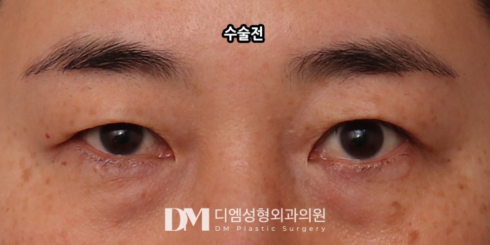 상안검, 눈꺼풀의 노화 해결하기 관련 이미지 10
