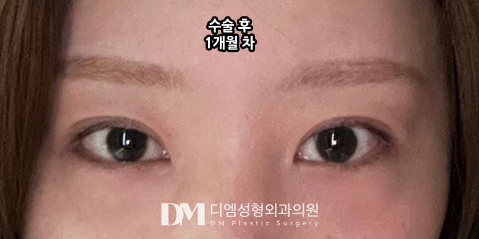 Lateral and Lower Canthoplasty for Softer, Gentler-Looking Eyes?! image 6