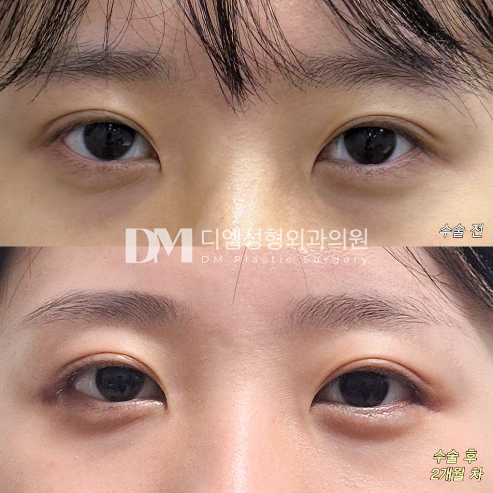 뒤밑트임 후기." 깔끔하고 시원하게 잘 트인 것 같아 만족합니다" 관련 이미지 2