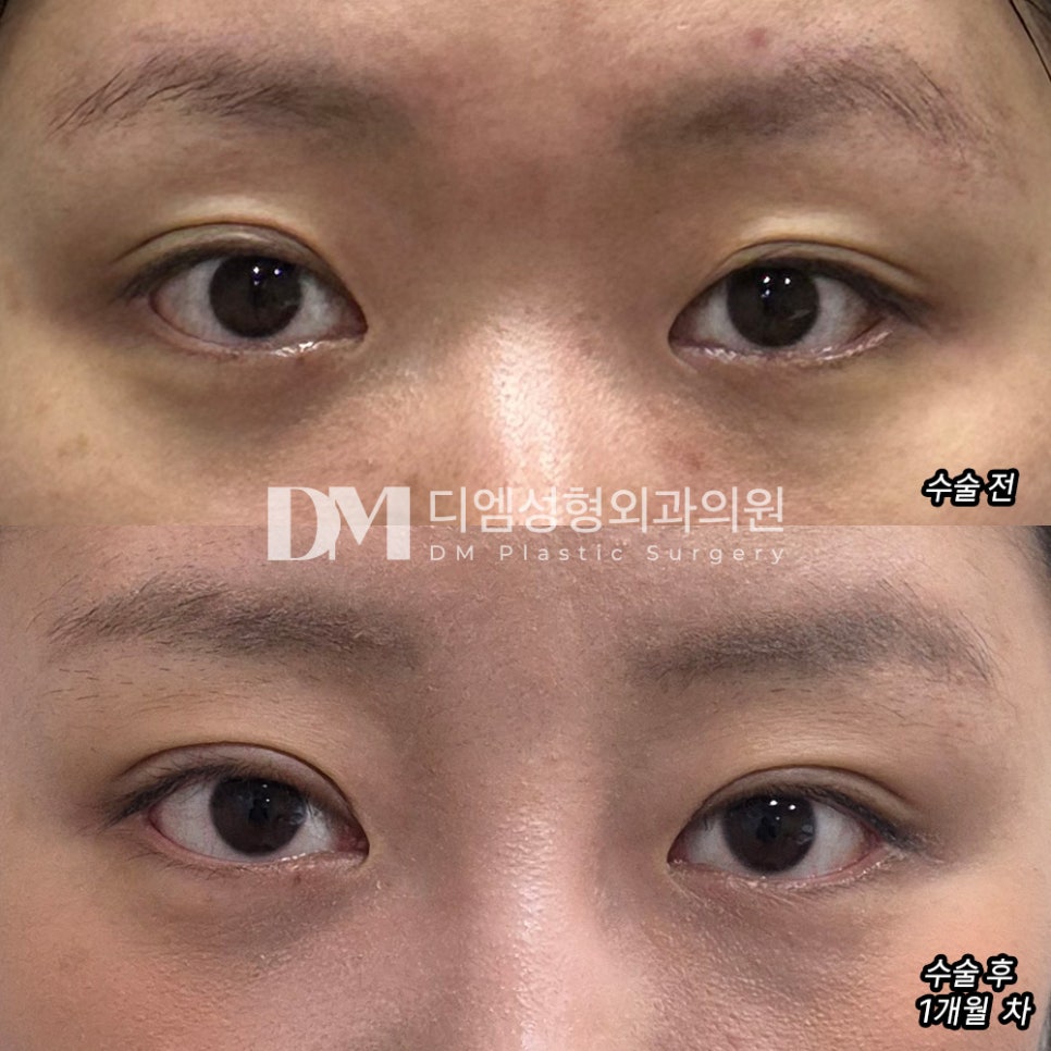 Ptosis Correction: If You’re Concerned About Looking Tired or Lacking Energy image 12