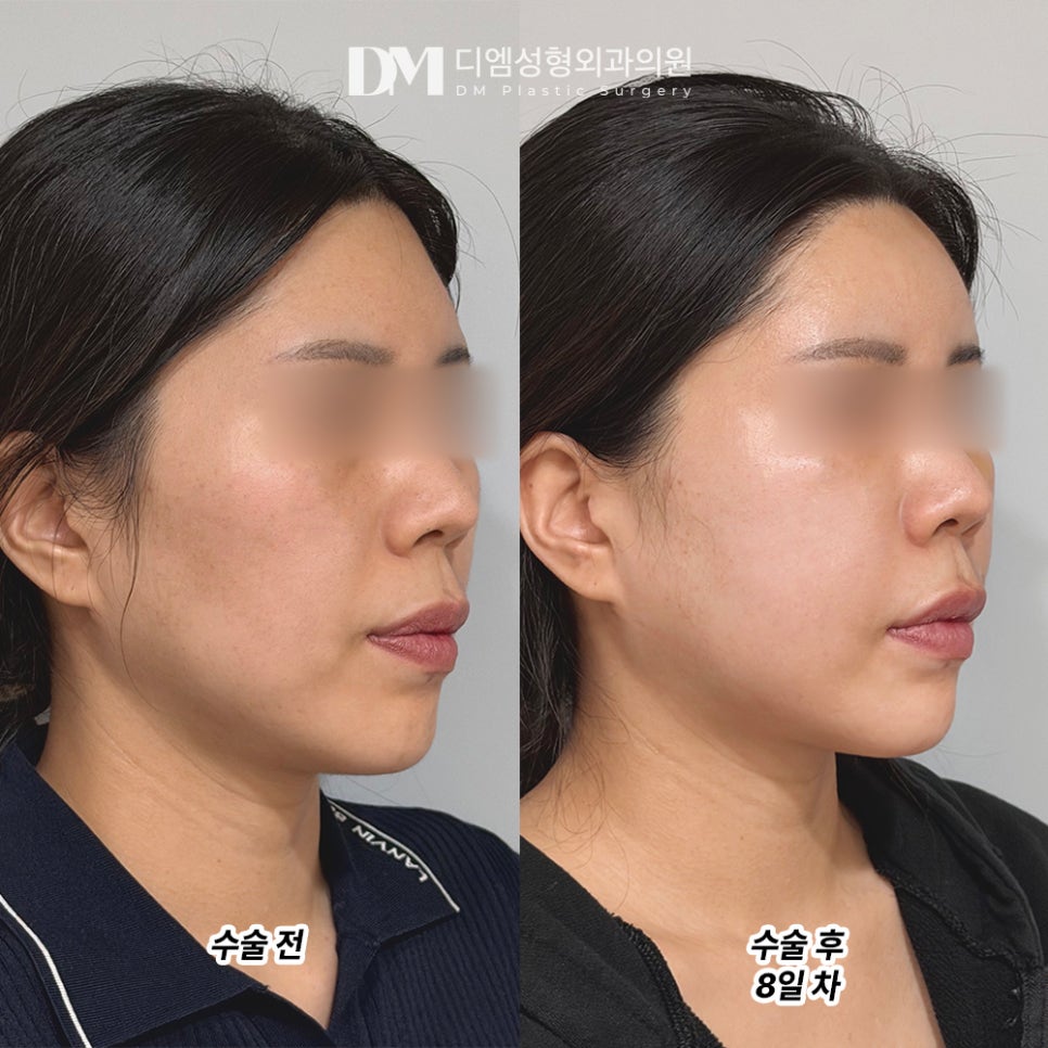 디엠 얼굴지방이식 전후사진, 얼굴에 볼륨을 더하면 생기는 변화 관련 이미지 2