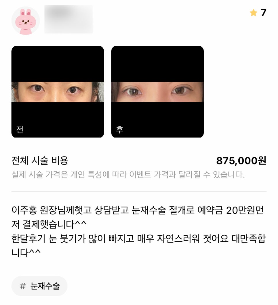 눈재수술 후기."매우 자연스러워졌어요 대만족합니다 ^^" 관련 이미지 1