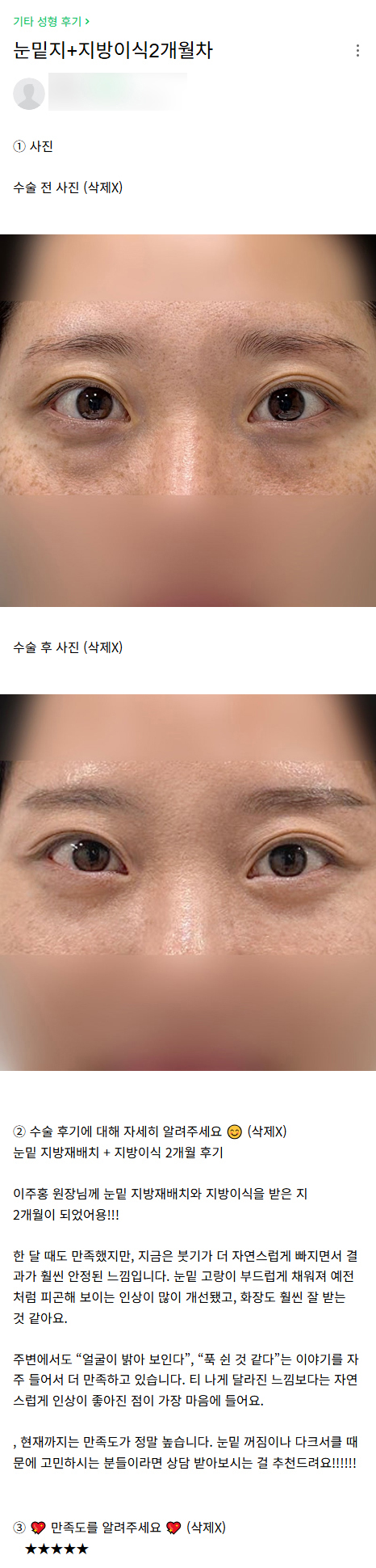 DM Lower Eyelid Fat Repositioning/Under-Eye Fat Grafting Surgery Review, &ldquo;I love how my overall impression improved naturally!&rdquo; image 1