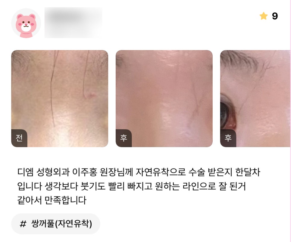 눈성형 후기."원하는 라인으로 잘 된거 같아서 만족해요!" 관련 이미지 1