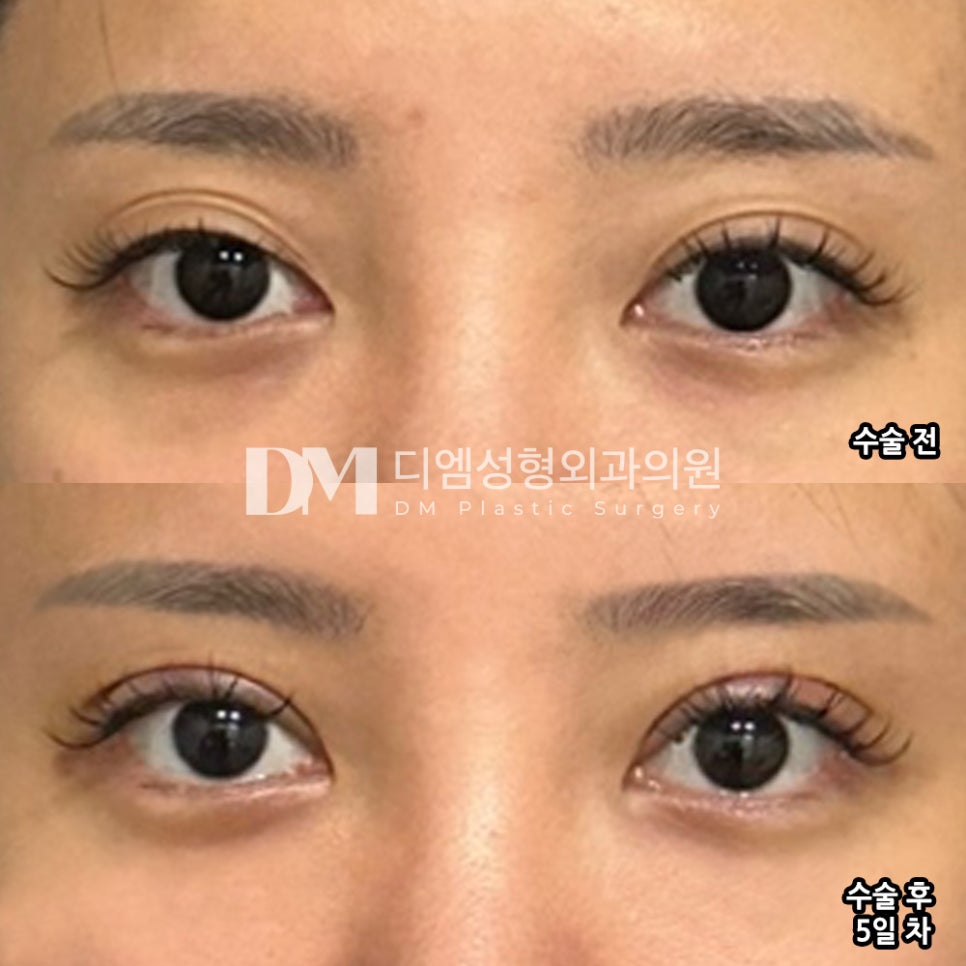 눈재수술 후기."어떻게 이렇게 붓기가 없냐고 놀랄 정도였어서 너무 만족하고 있어요! " 관련 이미지 2